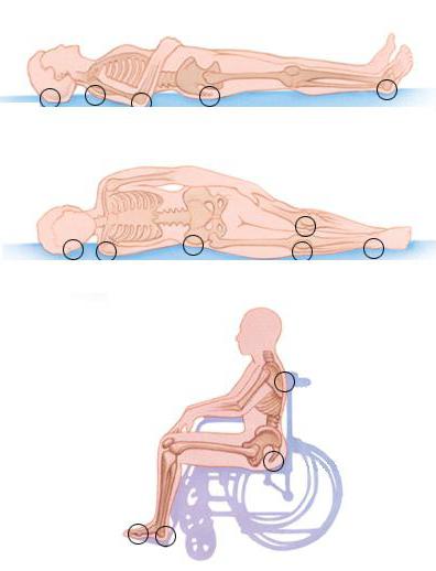 Основные виды положения больного в кровати