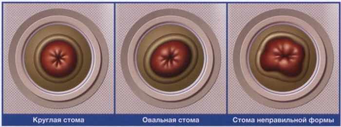 Абуцел или колопласт что лучше. %D0%BF%D0%BB%D0%B0%D1%81%D1%82%D0%B8%D1%87%D0%BD%D1%8B%D0%B5 %D0%BF%D0%BB%D0%B0%D1%81%D1%82%D0%B8%D0%BD%D1%8B. Абуцел или колопласт что лучше фото. Абуцел или колопласт что лучше-%D0%BF%D0%BB%D0%B0%D1%81%D1%82%D0%B8%D1%87%D0%BD%D1%8B%D0%B5 %D0%BF%D0%BB%D0%B0%D1%81%D1%82%D0%B8%D0%BD%D1%8B. картинка Абуцел или колопласт что лучше. картинка %D0%BF%D0%BB%D0%B0%D1%81%D1%82%D0%B8%D1%87%D0%BD%D1%8B%D0%B5 %D0%BF%D0%BB%D0%B0%D1%81%D1%82%D0%B8%D0%BD%D1%8B